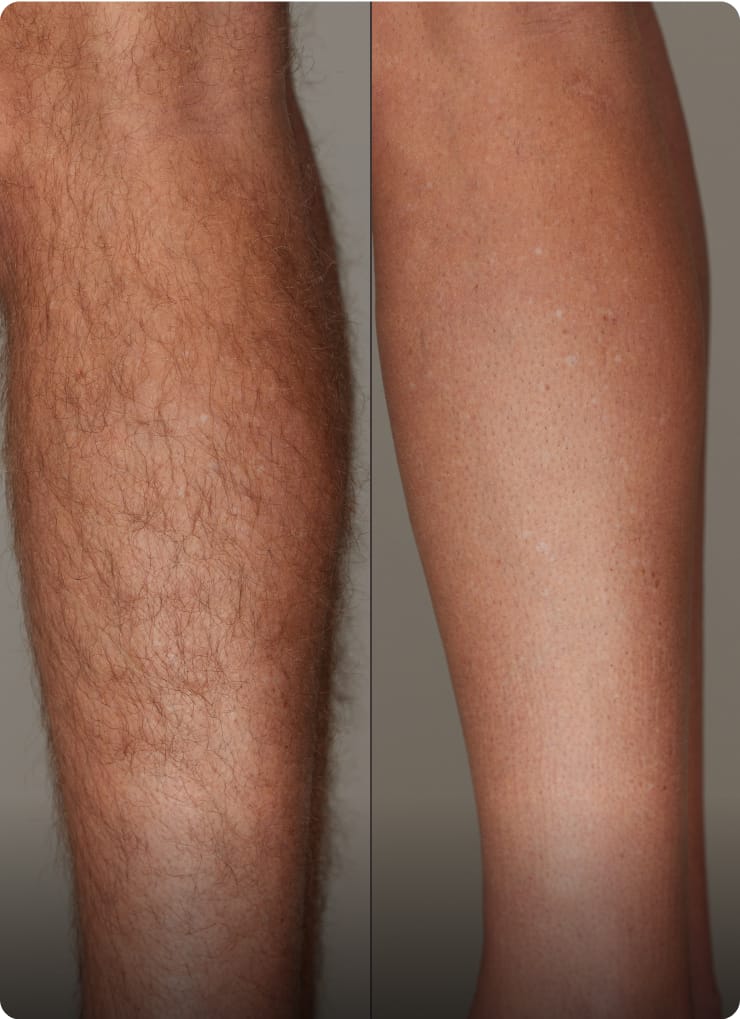 How does Ulike support its claim of 93% hair reduction in 4 weeks?