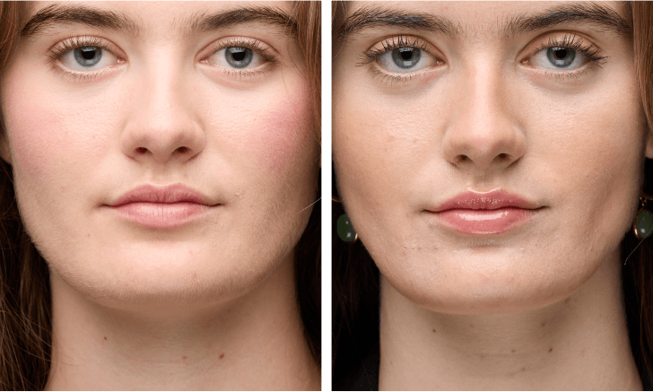 IPL hair removal results on Women’s Face before and after