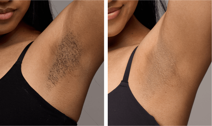 IPL hair removal results on Underarms before and after