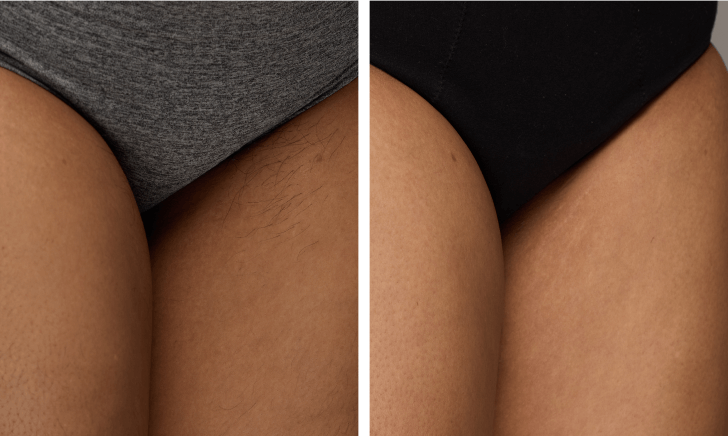 IPL hair removal results on bikini before and after
