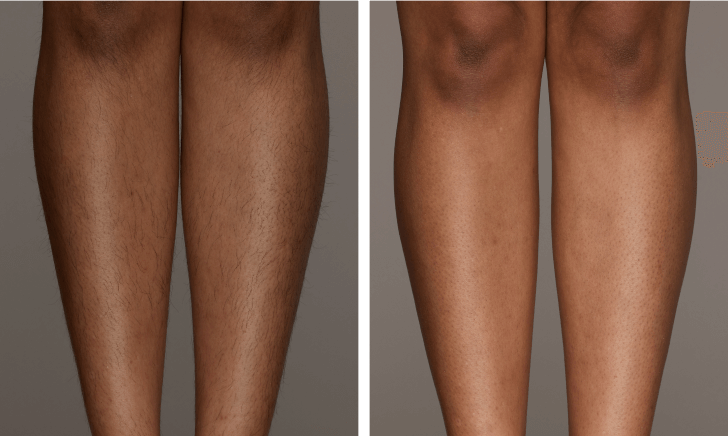IPL hair removal results on Men’s Legs before and after