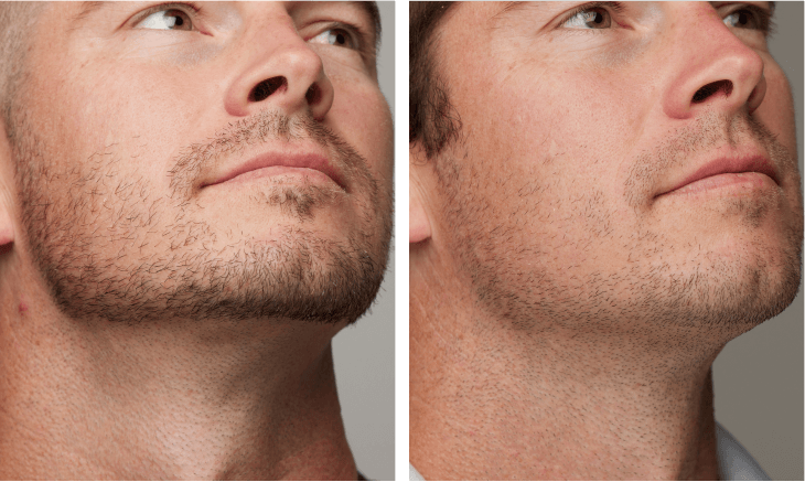 IPL hair removal results on Men’s Neck before and after