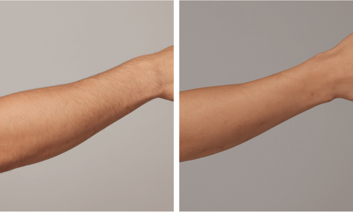 IPL hair removal results on Men’s Arms before and after