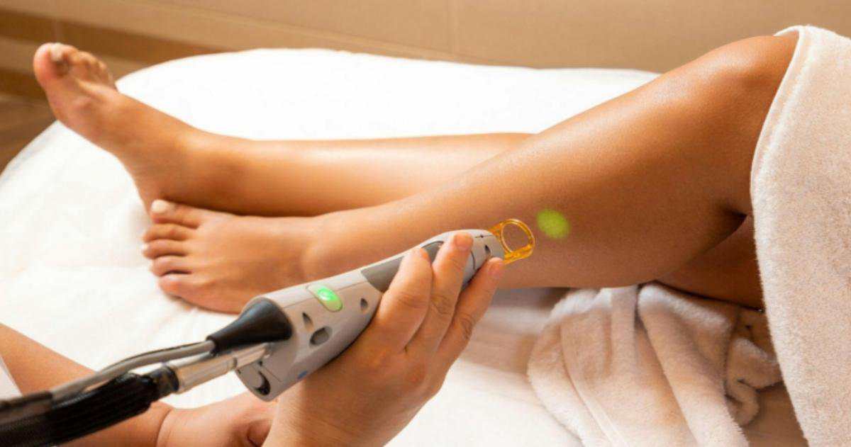 Does Laser Hair Removal Cause Infertility?