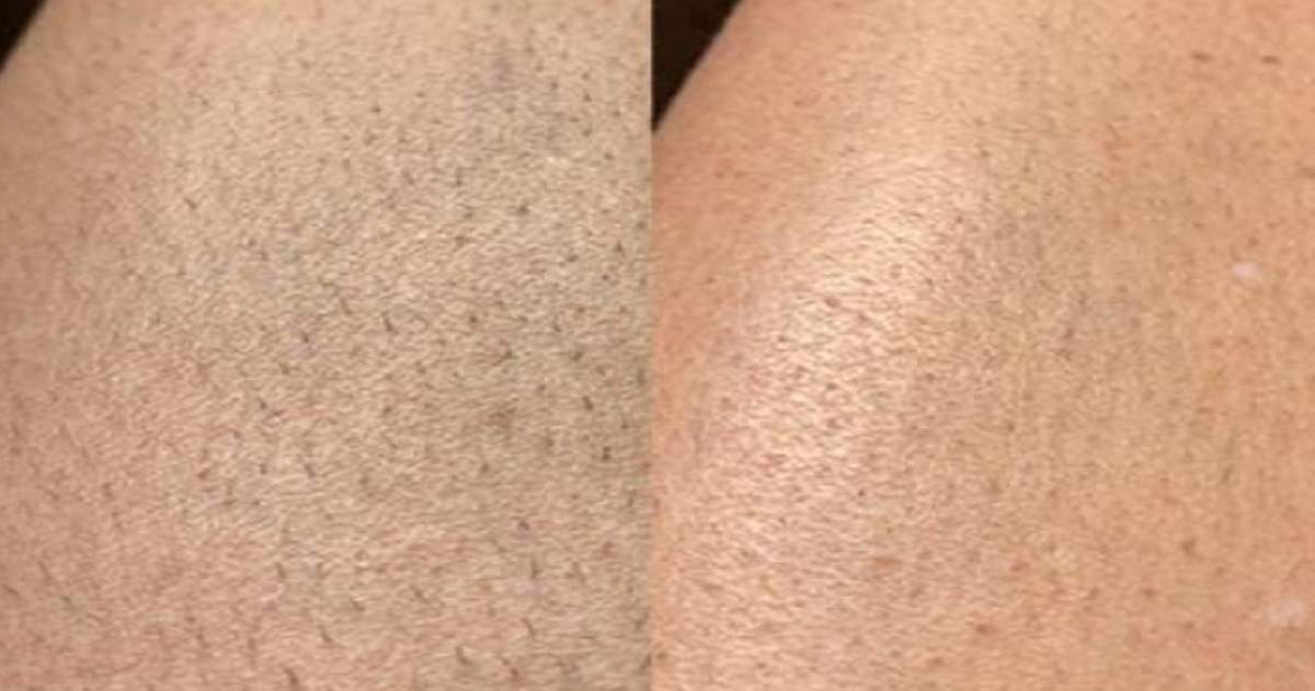 Does Peach Fuzz Grow Back Thicker And Darker After Shaving? - Ulike