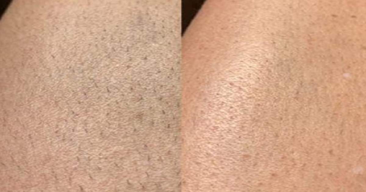 Does Peach Fuzz Grow Back Thicker And Darker After Shaving?