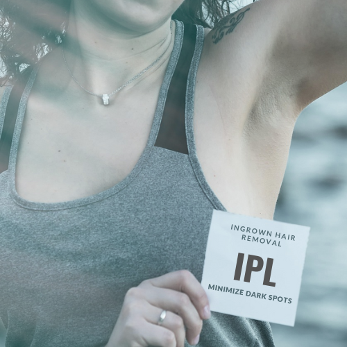 IPL for Ingrown hair removal and dark spots 
