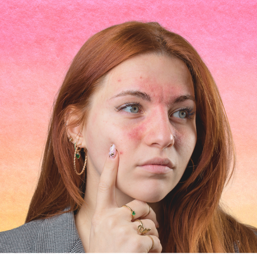 laser treatment for rosacea