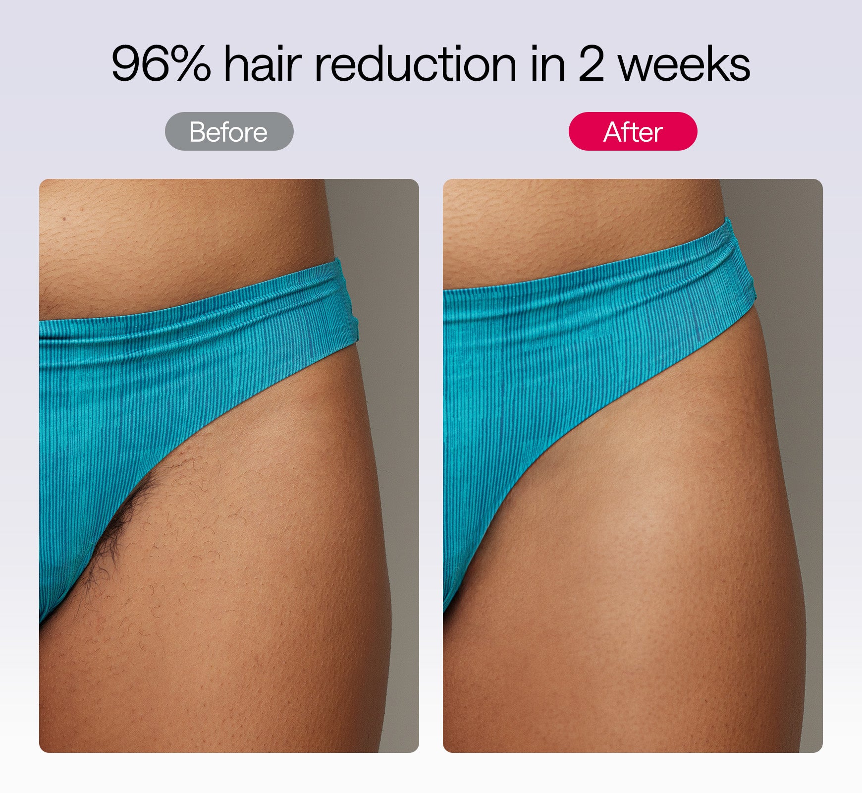 Ulike Air 10 IPL Hair Removal