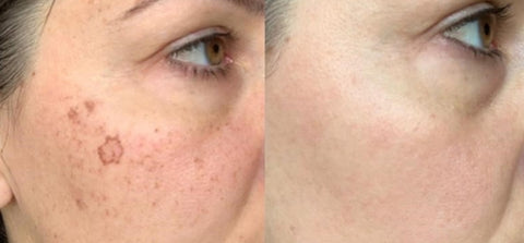 Are there any side effects of laser hair removal on face