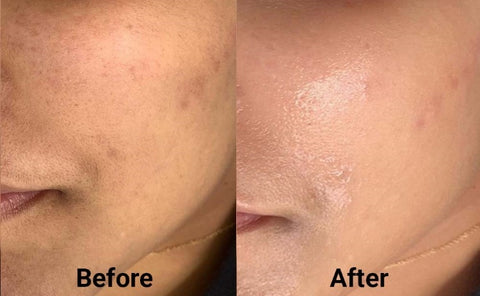 BB Glow Treatment Before and After