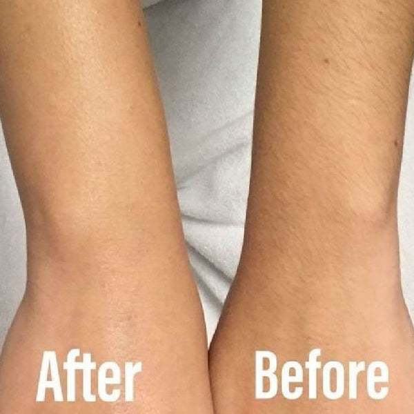 Bleach Arm Hair Before and After