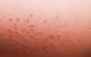 Burns, Bumps, and Bleeding