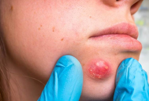 Can Stress Cause Boils