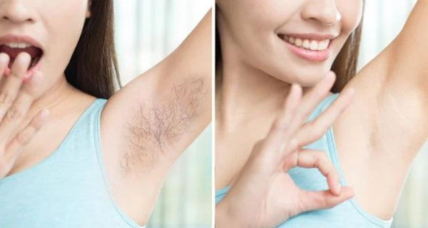 Electrolysis Hair Removal Before and After