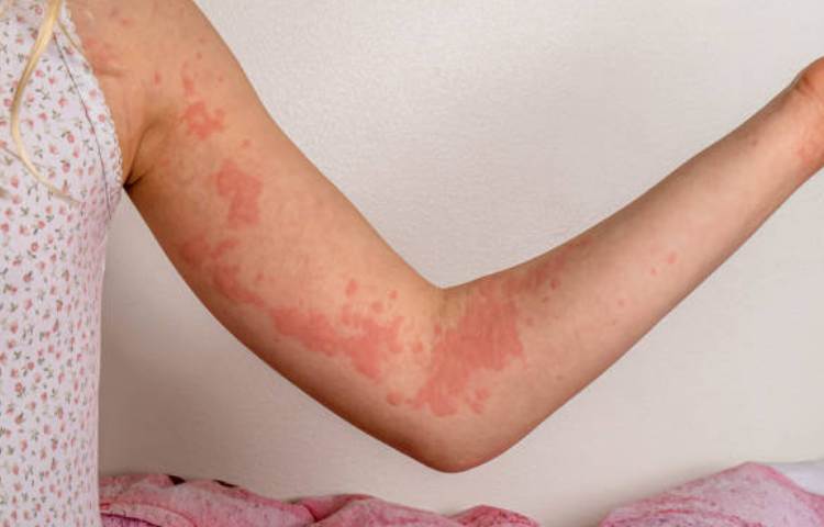 Why Do I Get Hives After Waxing