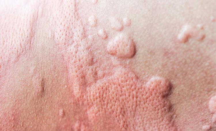 Is It Normal to Get Hives After Waxing