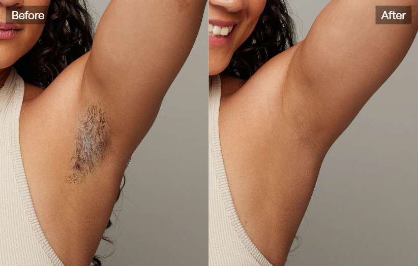 At-Home Laser Hair Removal Devices Actually Work