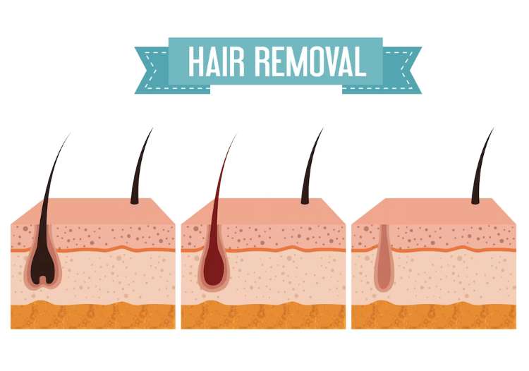 How Long Does Take for At-home Laser Hair Removal to Work