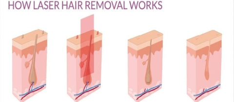 How does face laser hair removal work