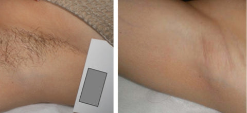 How much is laser hair removal for face