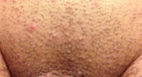 How to Get Rid of Razor Burn