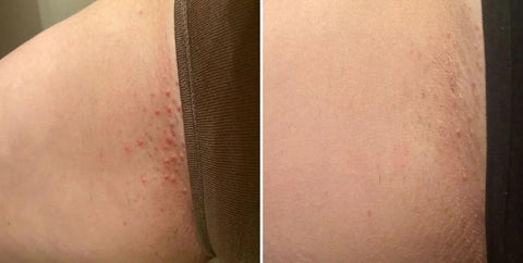 How to Stop Pain From Razor Burn