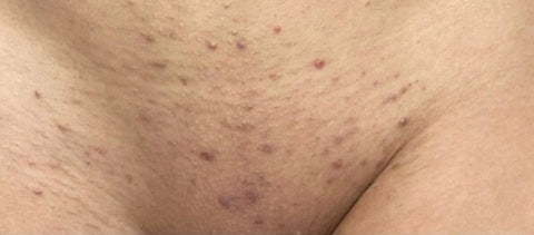 Important Precautions For The Next Brazilian Waxing Sessions