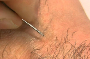 Ingrown hairs
