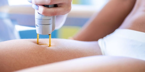 Laser Hair Removal Patch Test Reaction