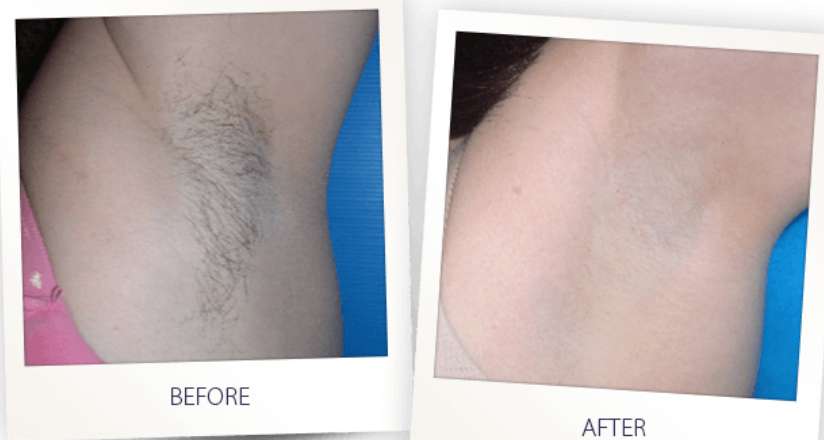 Necessary to Do Pre- and Post-Care for Laser Hair Removal at Home