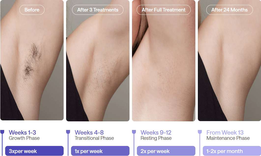 Recommended Treatment Schedule for At-Home Laser Hair Removal
