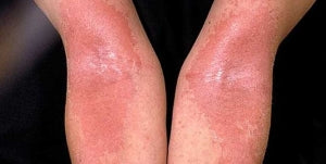 Skin Sensitivity & Allergic Reactions