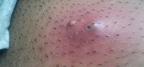 Suffering From Terrible Ingrown Hairs After Waxing Solutions Here