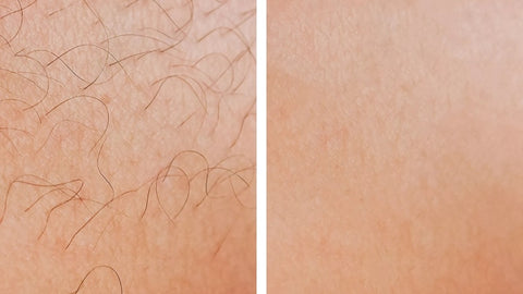 Tips To Get The Best Results From Laser Hair Removal