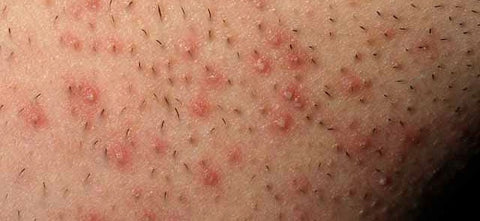What Causes Razor Burn
