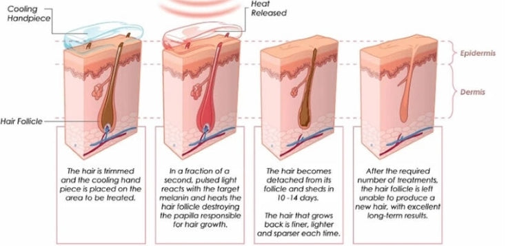 What Is At-Home Laser Hair Removal Work