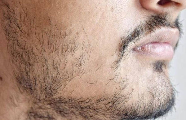 Why Can't I Grow a Beard