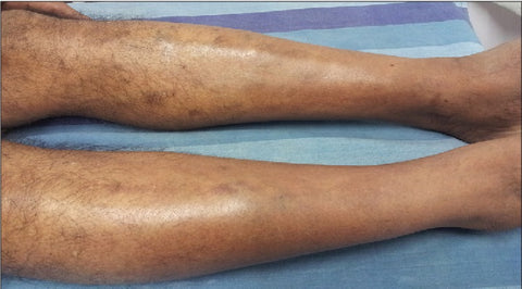 Why Do Guys Lose Hair on Their Legs