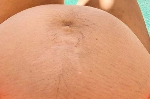 Why Is My Belly Hairy During Pregnancy