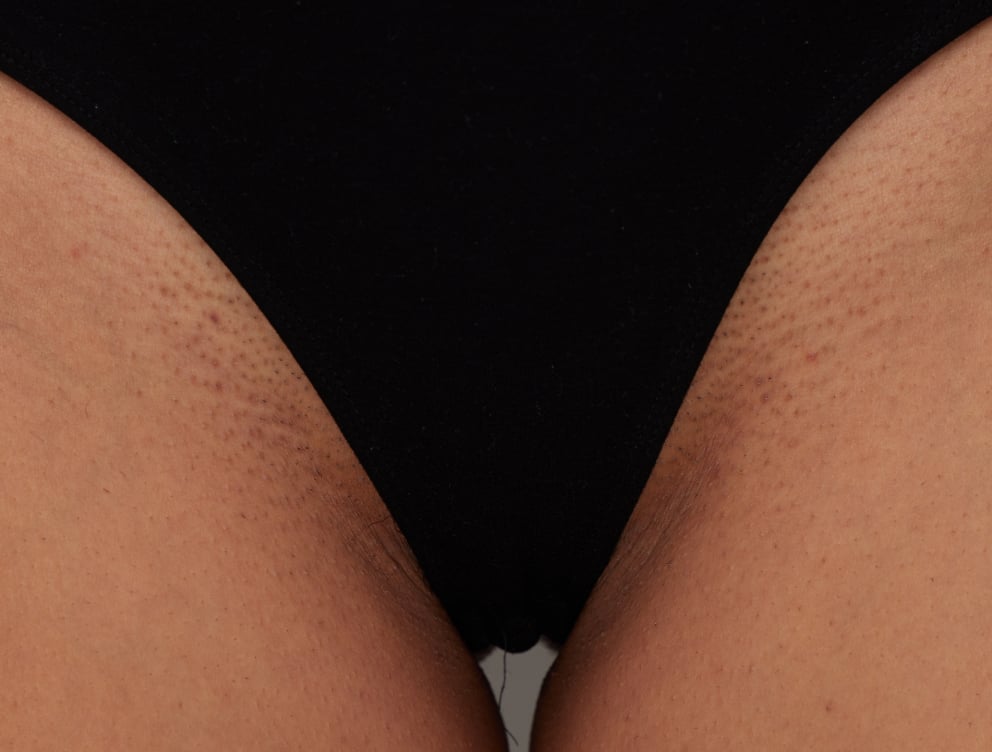 uk-homepage-bikini-hair-removal-before